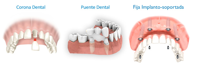 tipos-de-protesis-dentales-coronas