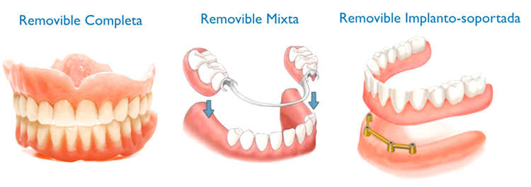 tipos-de-protesis-dentales